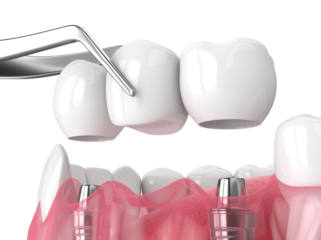 Model of an implant-supported dental bridge