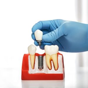 dental implants London Ontario London, ON