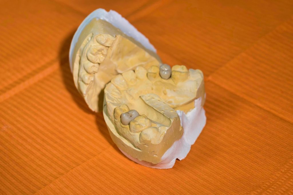 Dental lab mouth cast with crown restorations on prepared teeth against an orange background