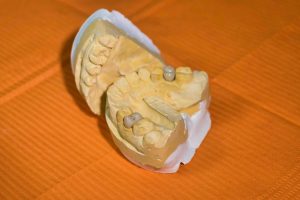 Dental lab mouth cast with crown restorations on prepared teeth against an orange background