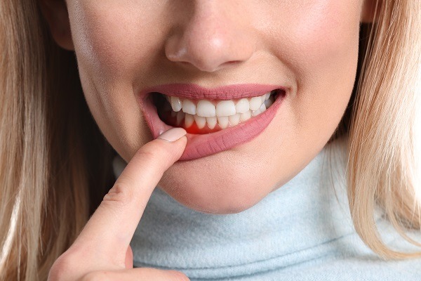 Woman pointing to her gums while smiling